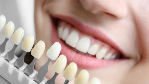 in chair teeth whitening perth
