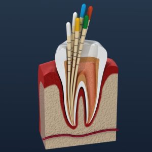 emergency root canal​