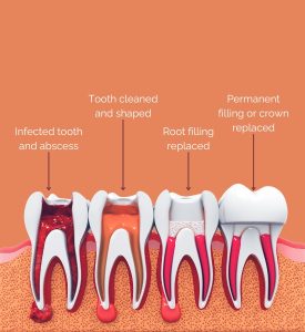 root canal or tooth out