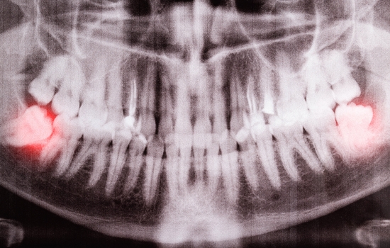 removal of wisdom teeth near me