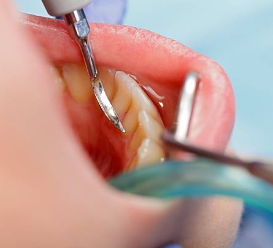 teeth cleaning deep cleaning​