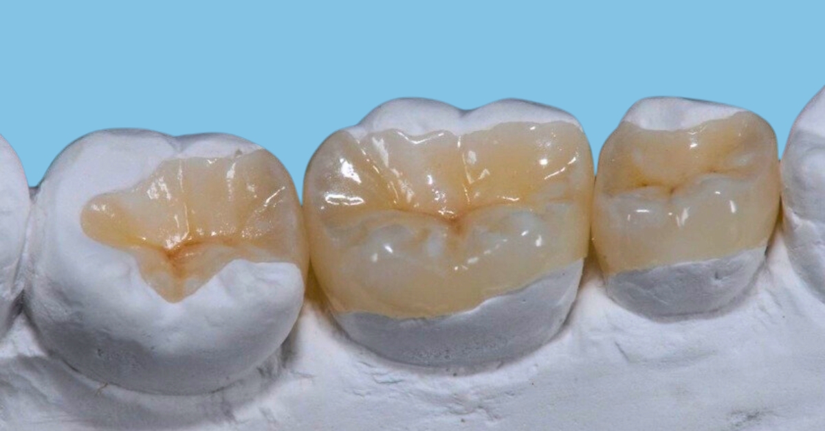 dental inlays and onlays