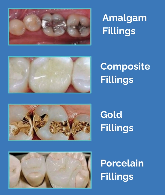 types of dental fillings