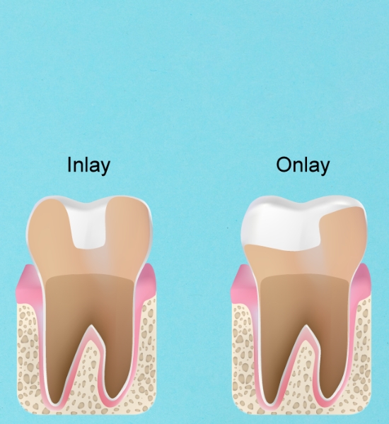 wanneroo dental inlays and onlays dentist