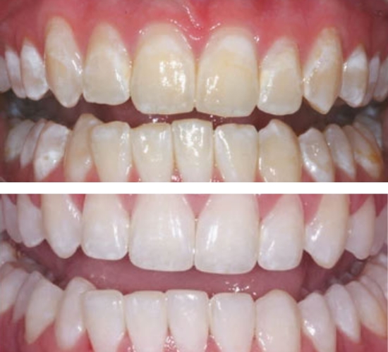 tooth discolouration