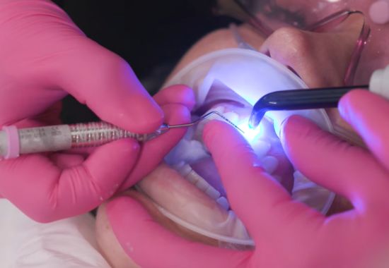 dental veneers perth