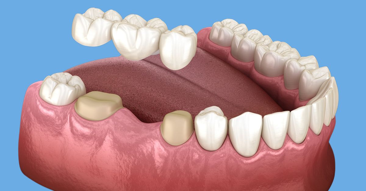 dental bridges