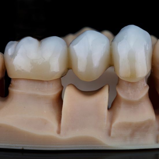 dental crown bridge