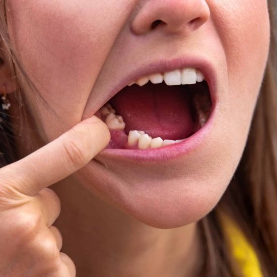 dental bridge