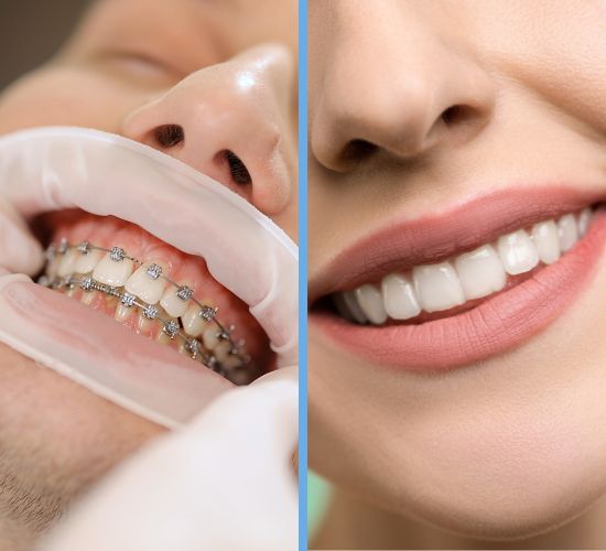 dental veneer alternative
