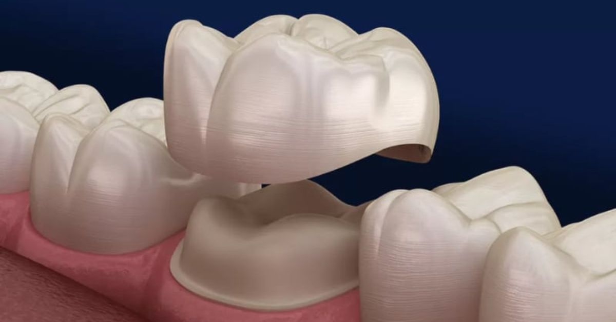 dental crown