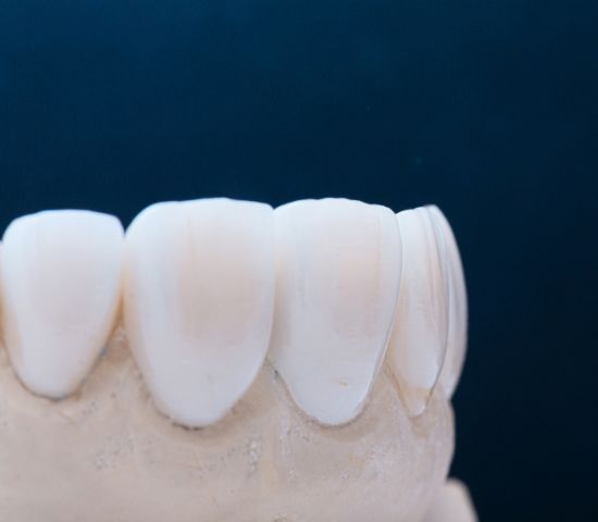 dental crown possible complications