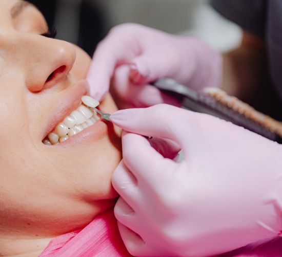 cost of veneers dental