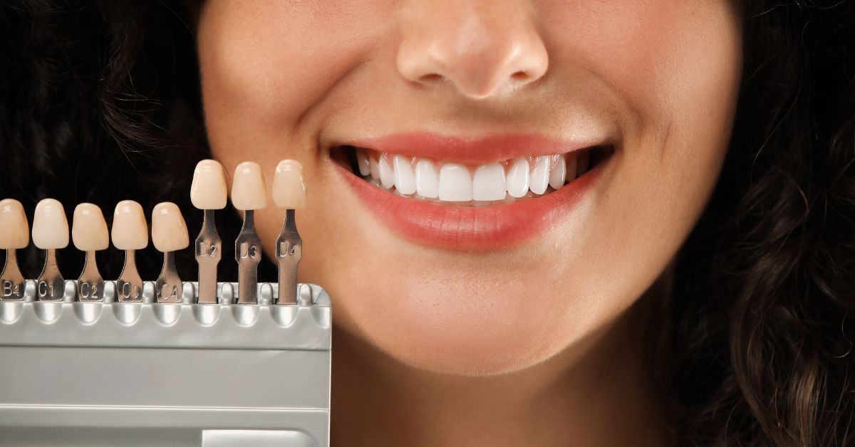 dental veneers