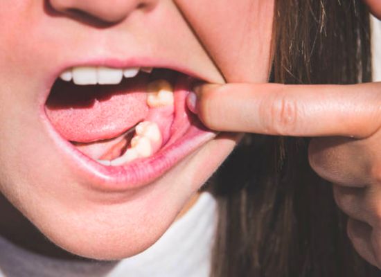 bridge dental