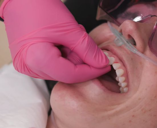 dental composite veneers cost