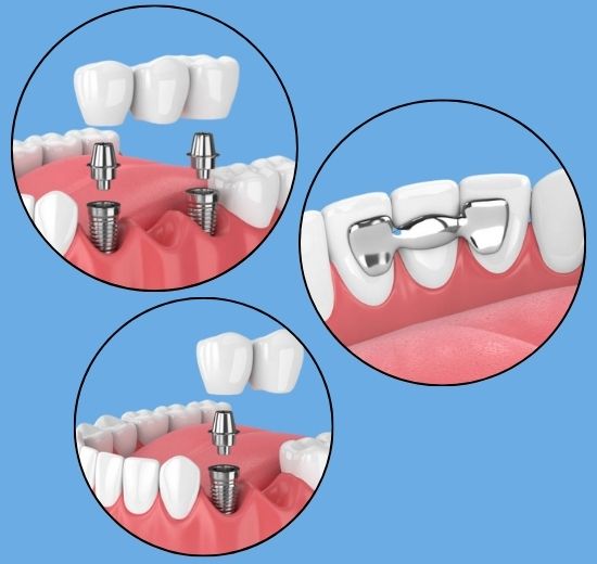 types of dental bridge