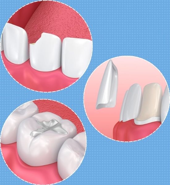 dental crowns alternatives