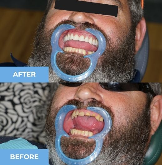 dental bridge before and after