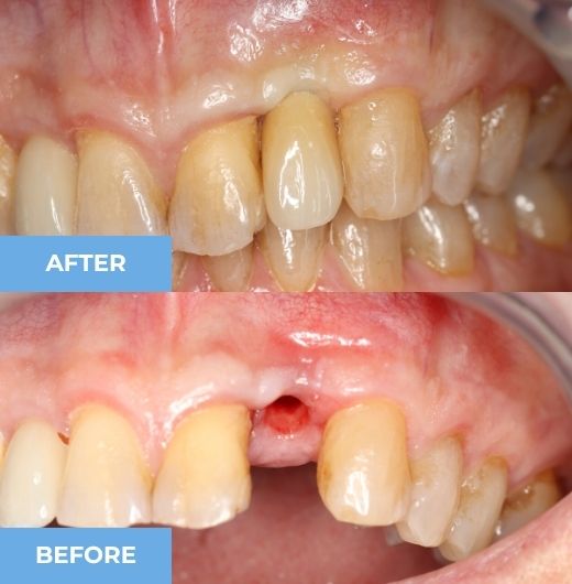 dental crown-2