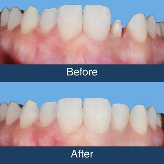 dental crown before and after