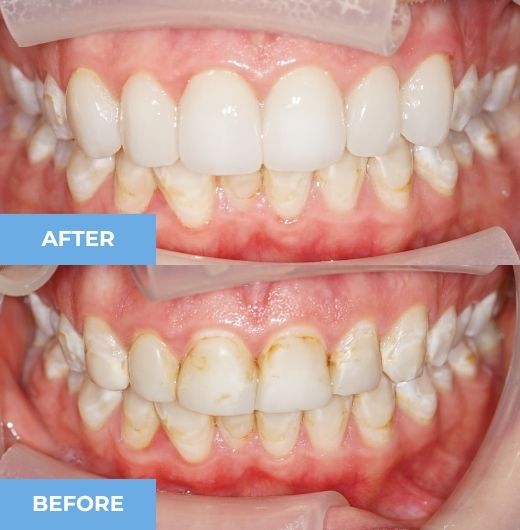 porcelain veneers before and after