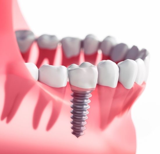 what is tooth implant