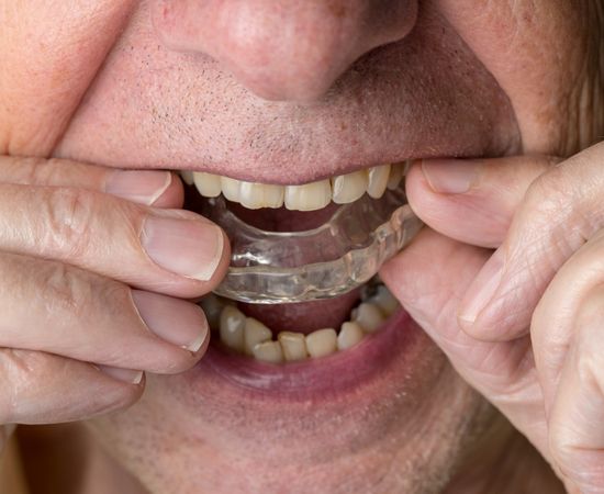 dental night splint