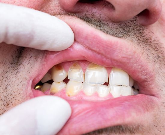 mouth splint for bruxism