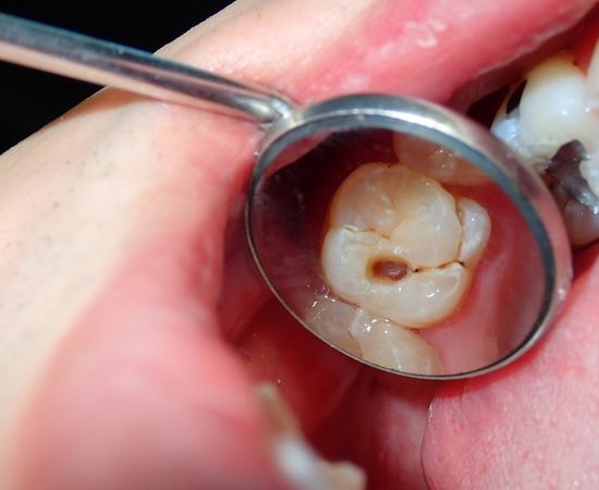 tooth sensitivity treatment