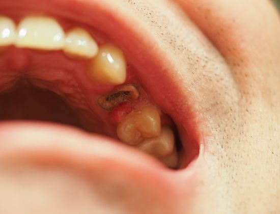 dental broken tooth repair