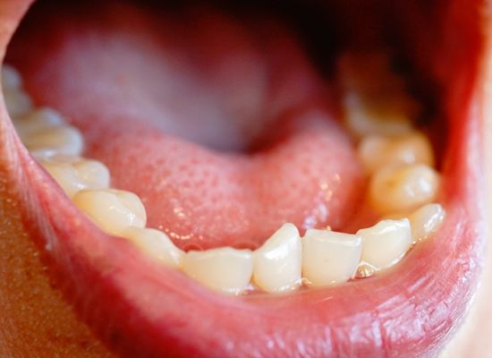 cause of crooked teeth