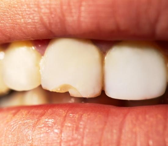 chipped tooth repair cost