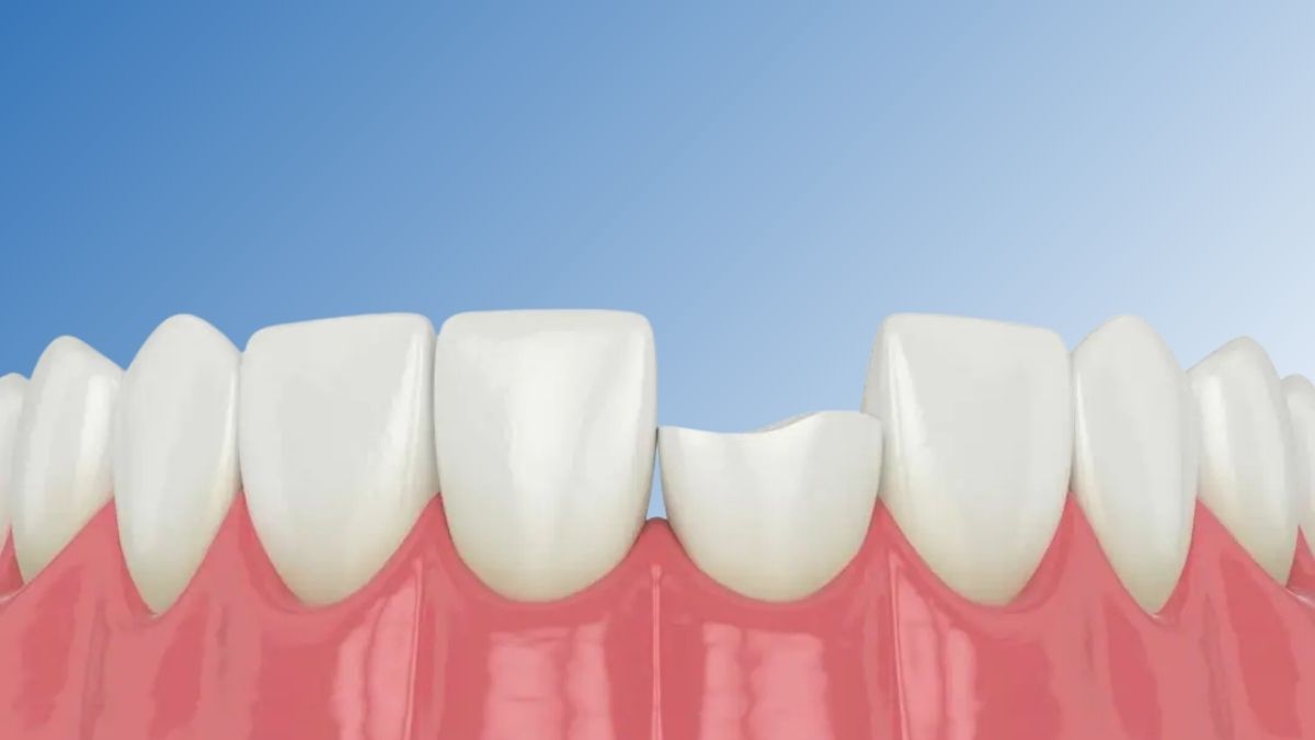 broken tooth repair