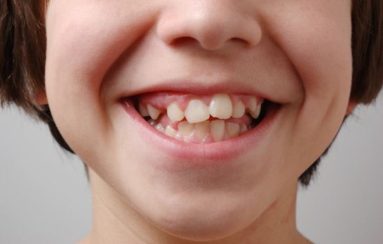 crooked bottom teeth