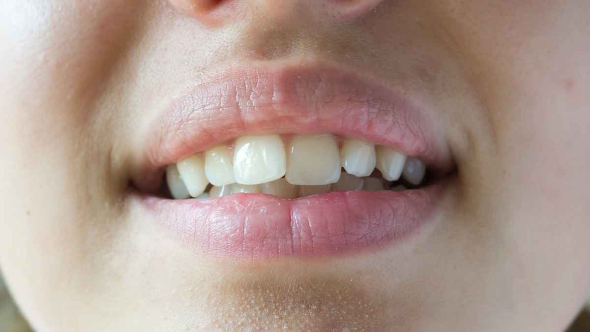 crooked teeth