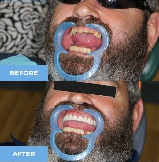 dental bridge before and after