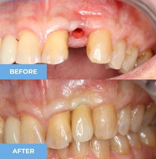dental crown