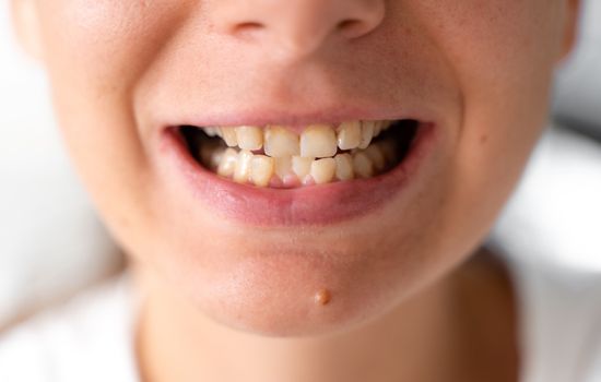how to fix crooked teeth
