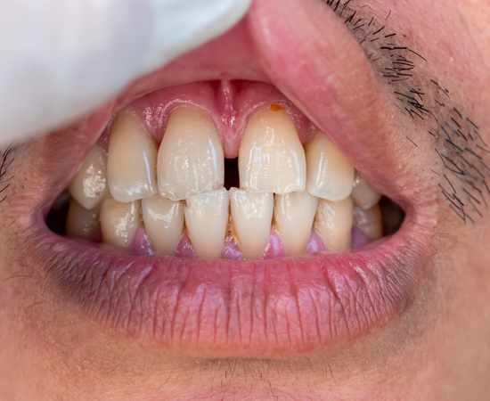 how to fix gap in front teeth