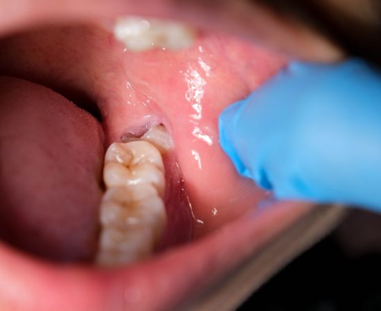 pain with wisdom teeth