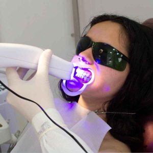 in chair teeth whitening