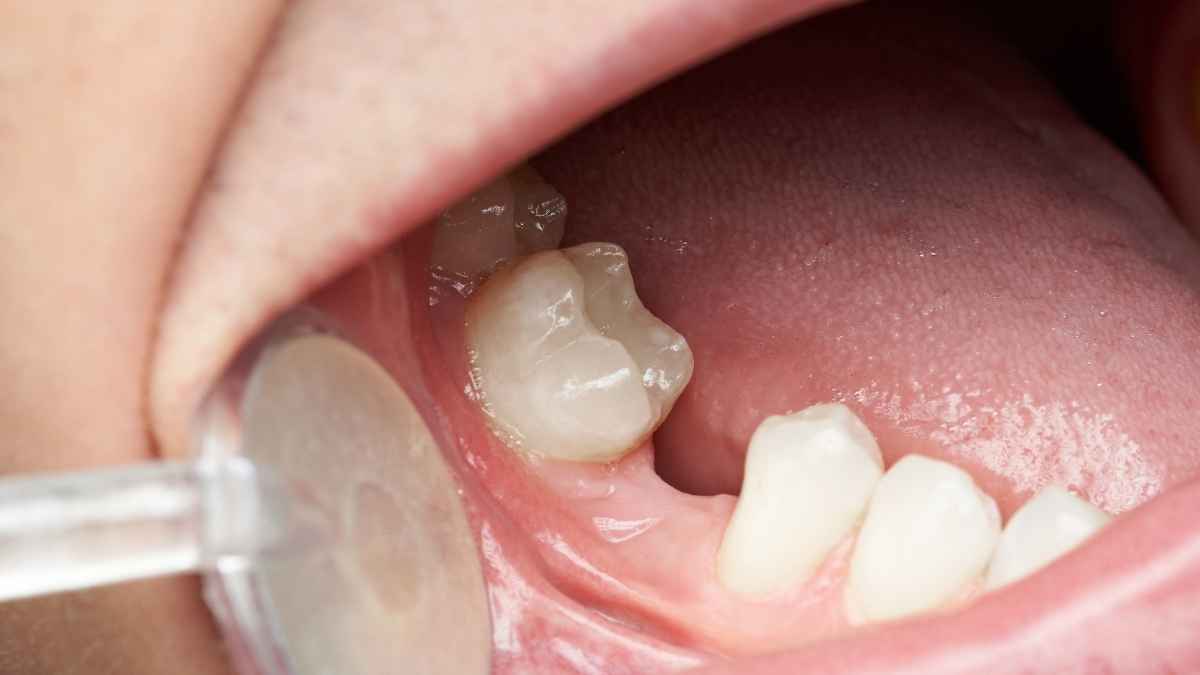 loose teeth