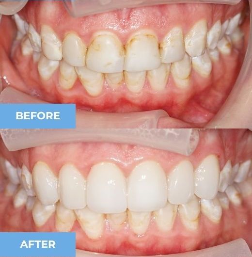 porcelain veneers before and after