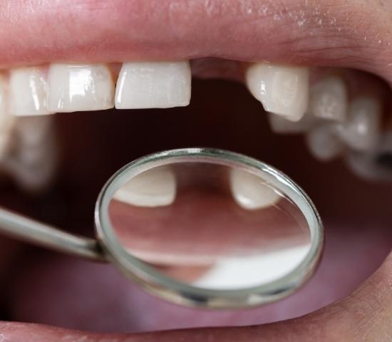cheap options for missing teeth