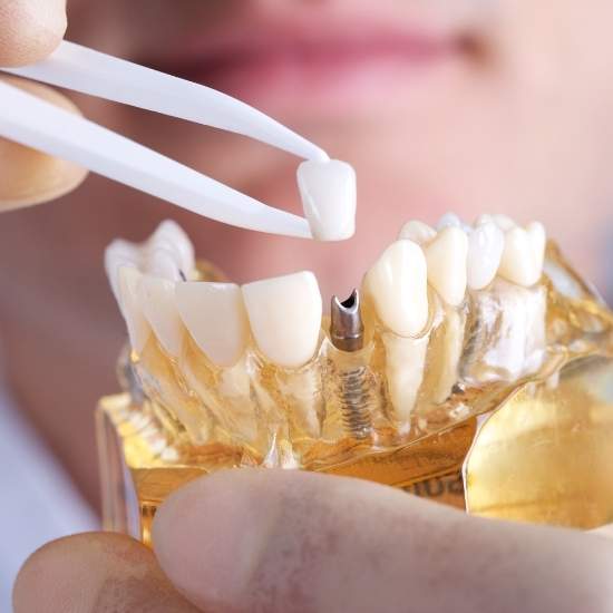 missing lateral teeth