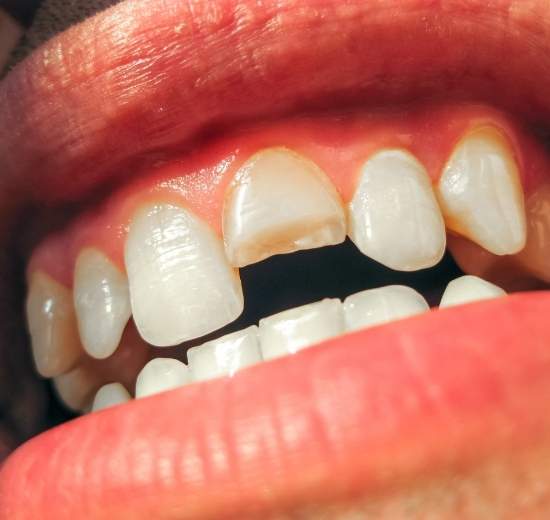 broken tooth