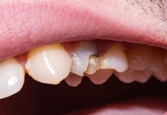 chipped tooth repair