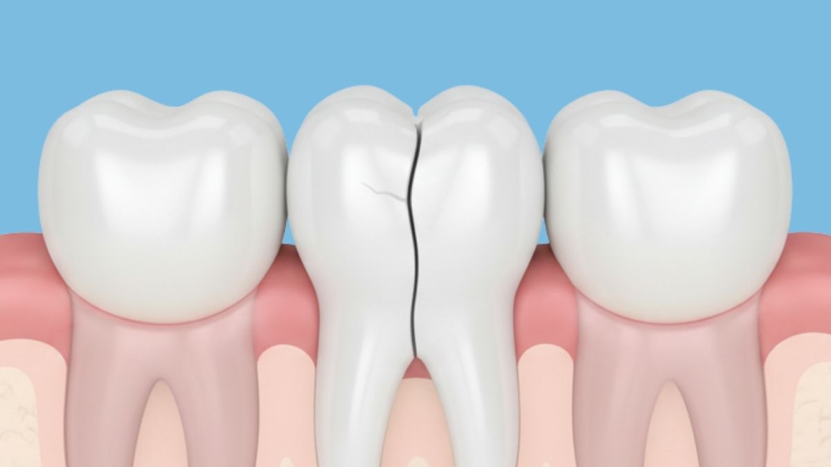 crack in tooth