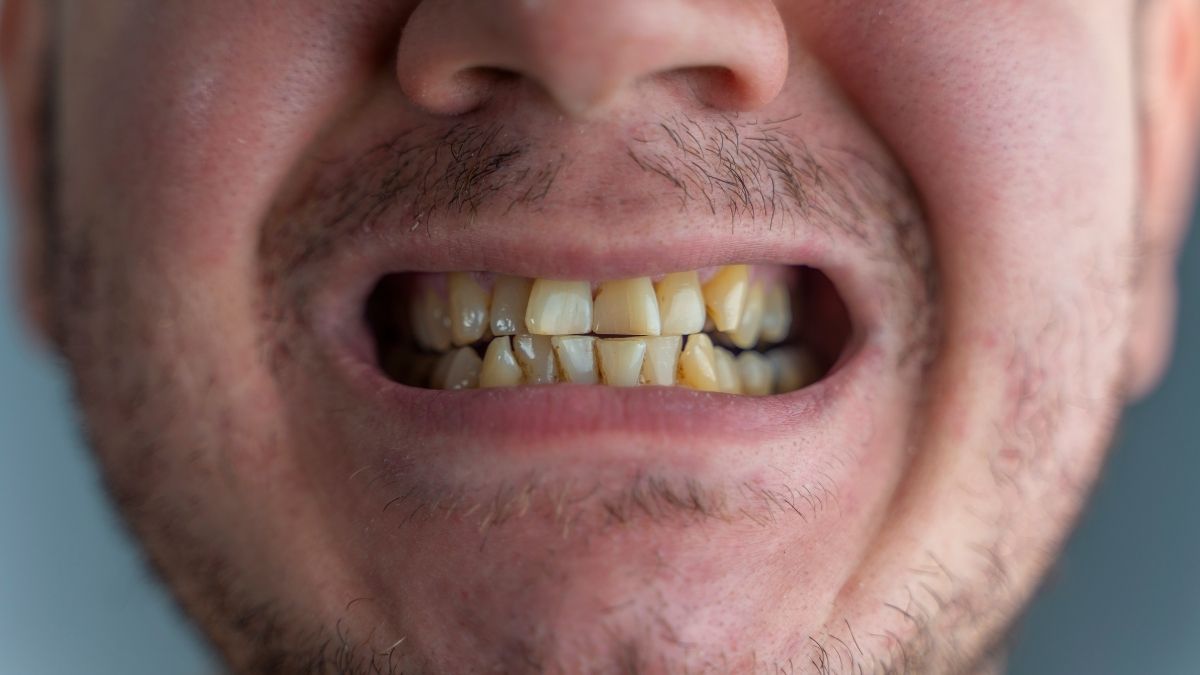 stained teeth